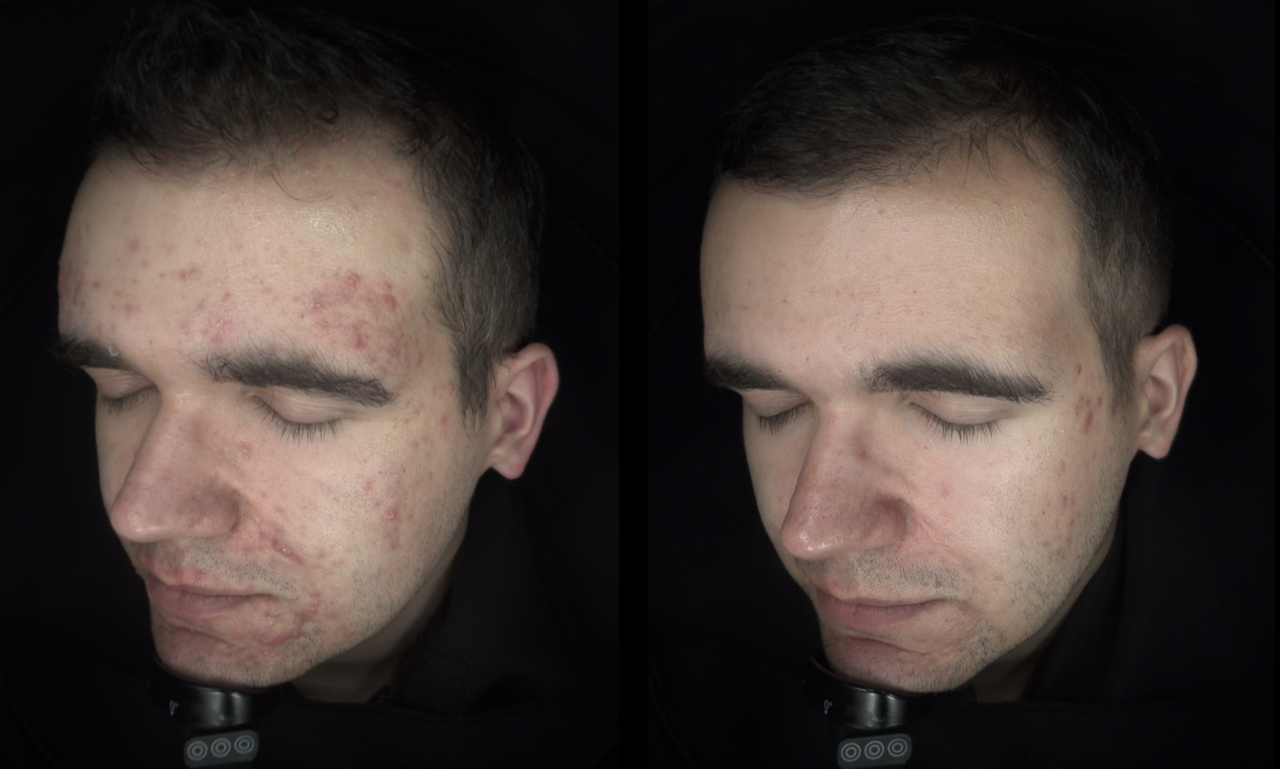 Laser treatment for acne at Harmony Medical