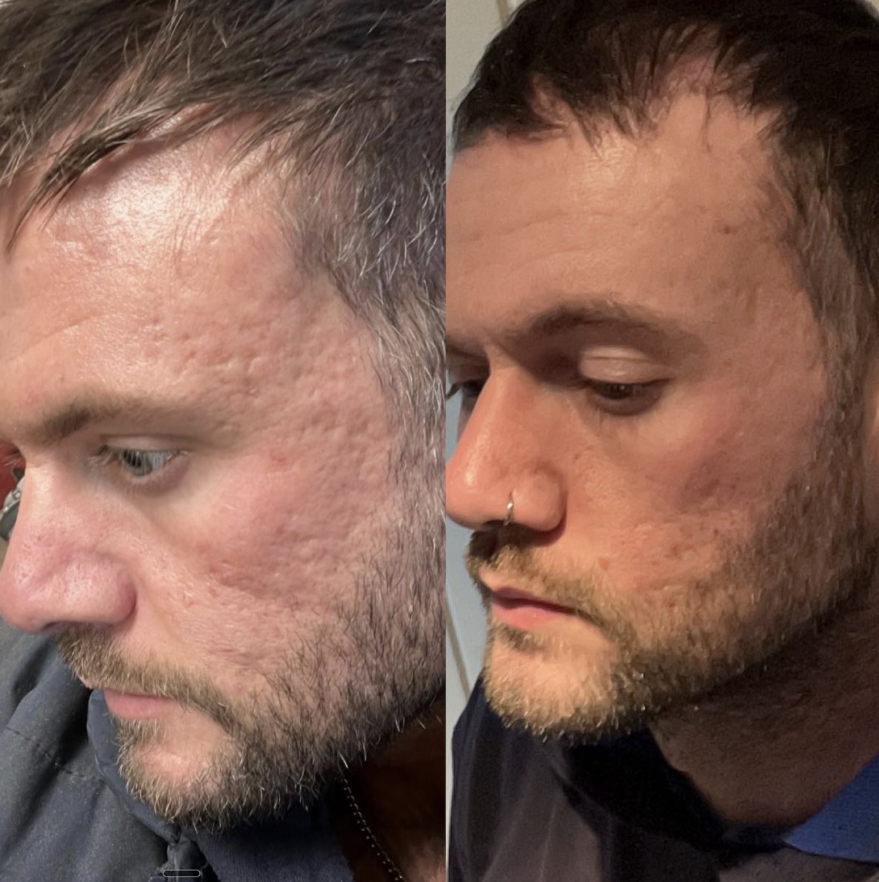 Laser treatment for acne at Harmony Medical