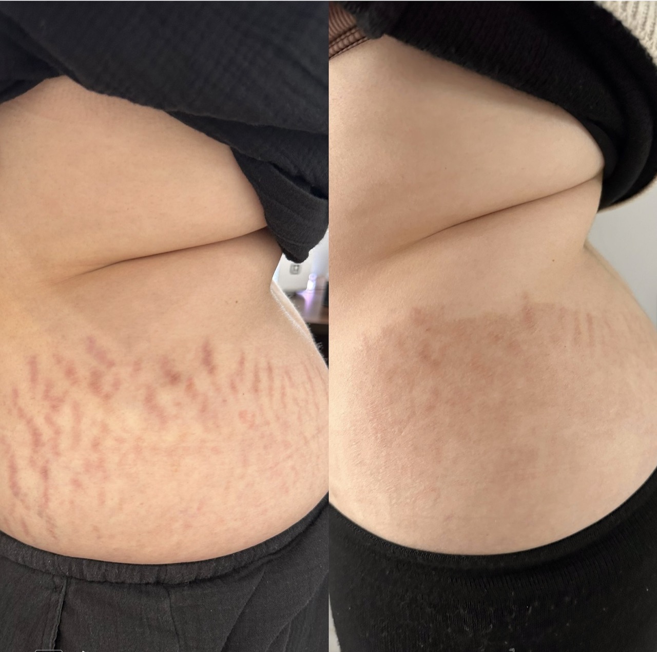 Treatment room for scar and texture treatment at Harmony Medical