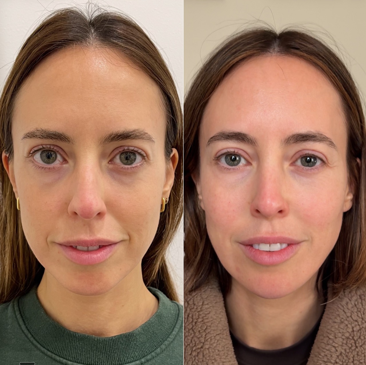 Treatment room for scar and texture treatment at Harmony Medical