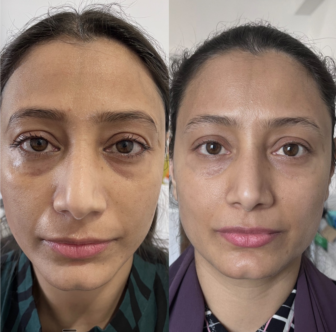 Treatment room for scar and texture treatment at Harmony Medical