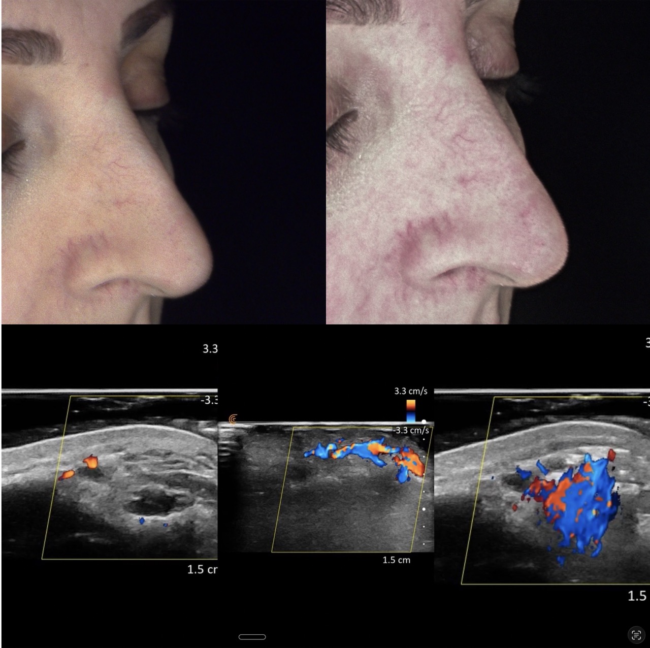Ultrasound assessment of filler complications at Harmony Medical