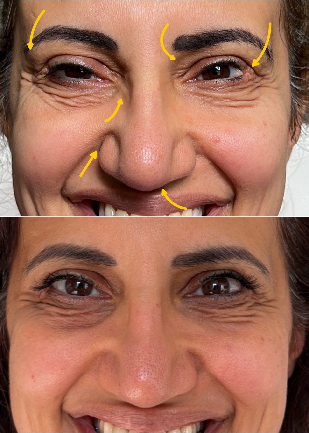 Ultrasound assessment of filler complications at Harmony Medical