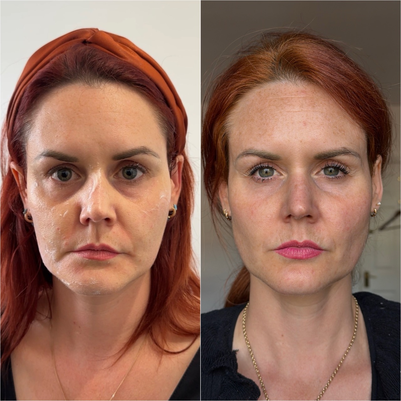 Ultrasound assessment of filler complications at Harmony Medical