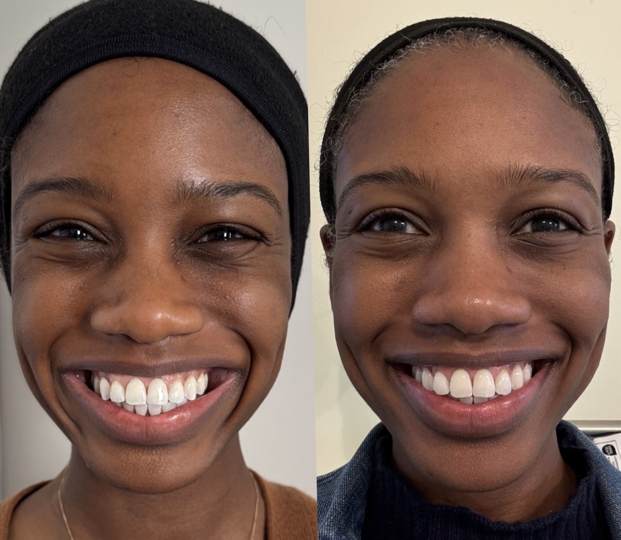 Ultrasound assessment of filler complications at Harmony Medical