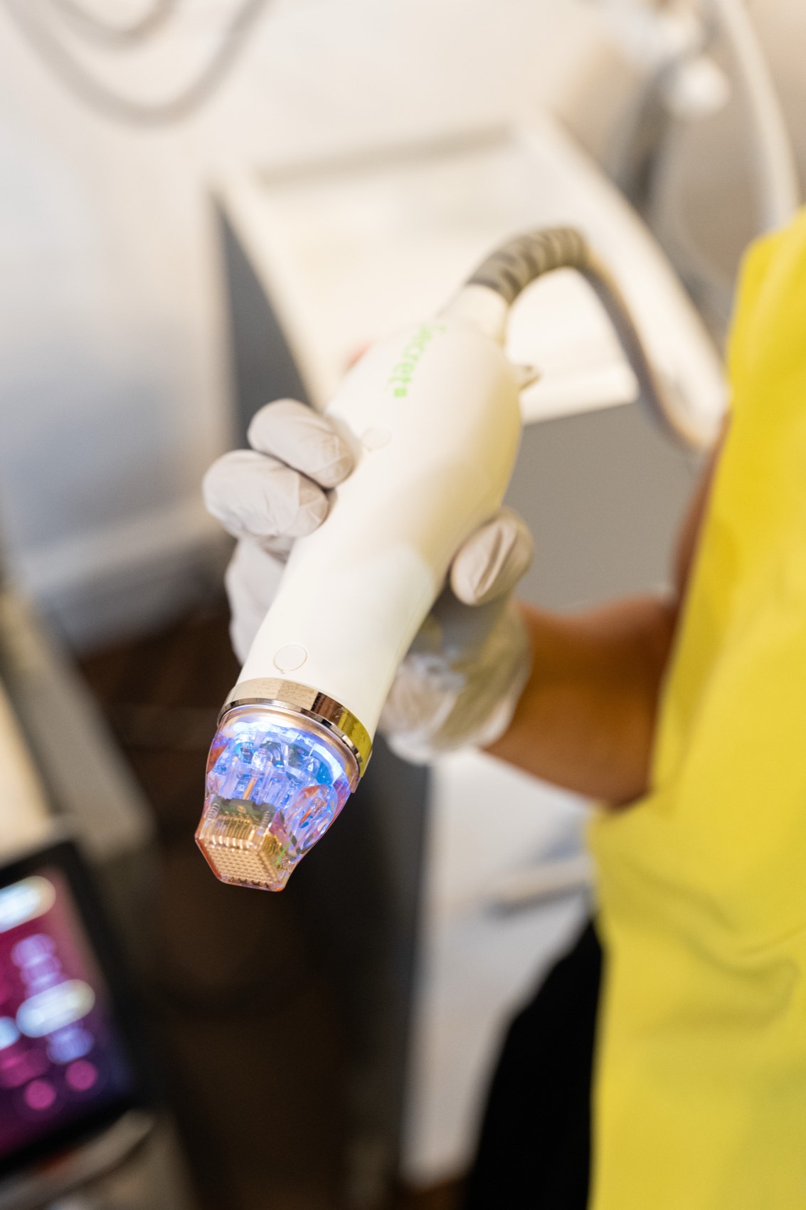 Precision applicator used for targeted acne scar treatment at Harmony Medical