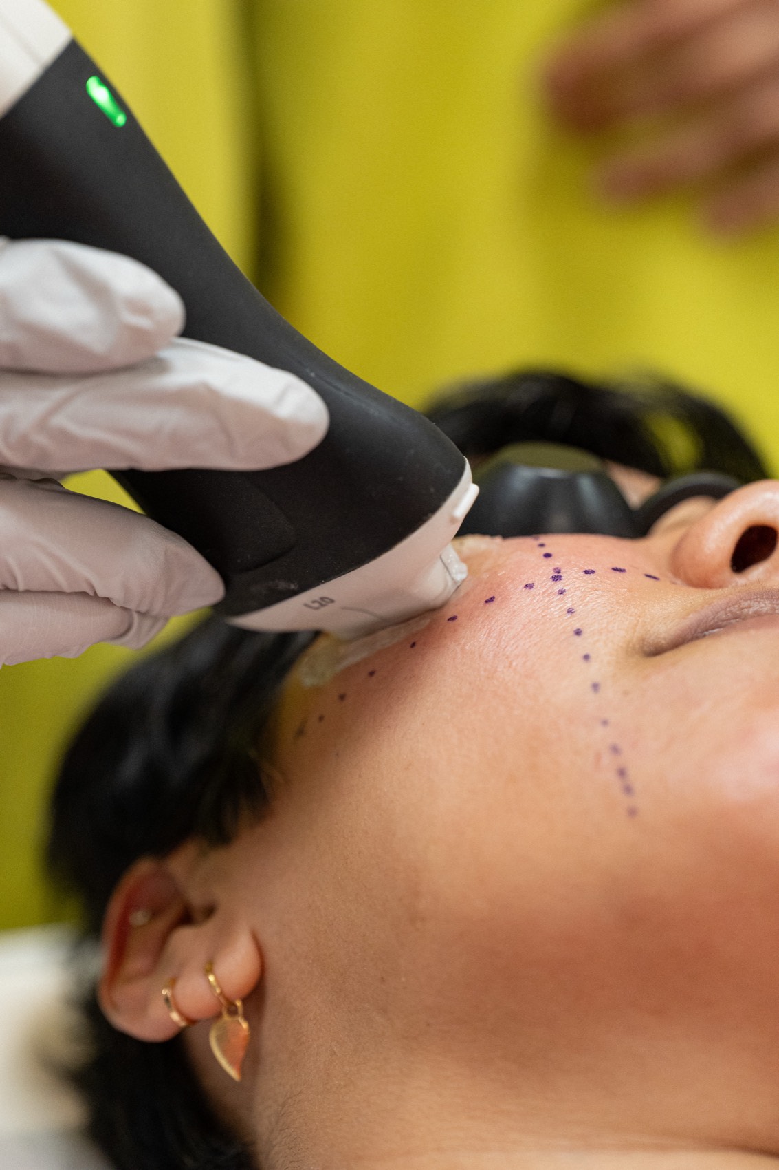 Clinician mapping injection points on a patient at Harmony Medical