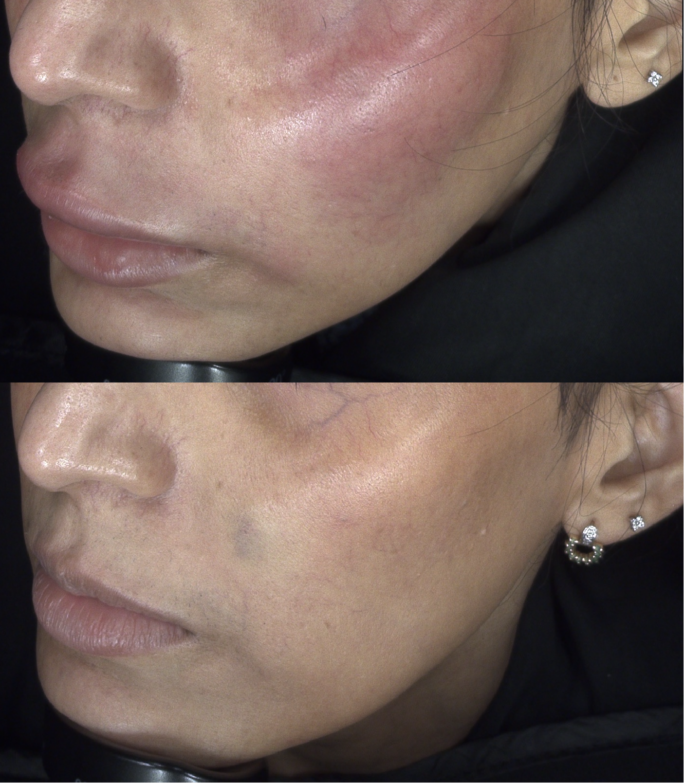 Filler before and after at Harmony Medical
