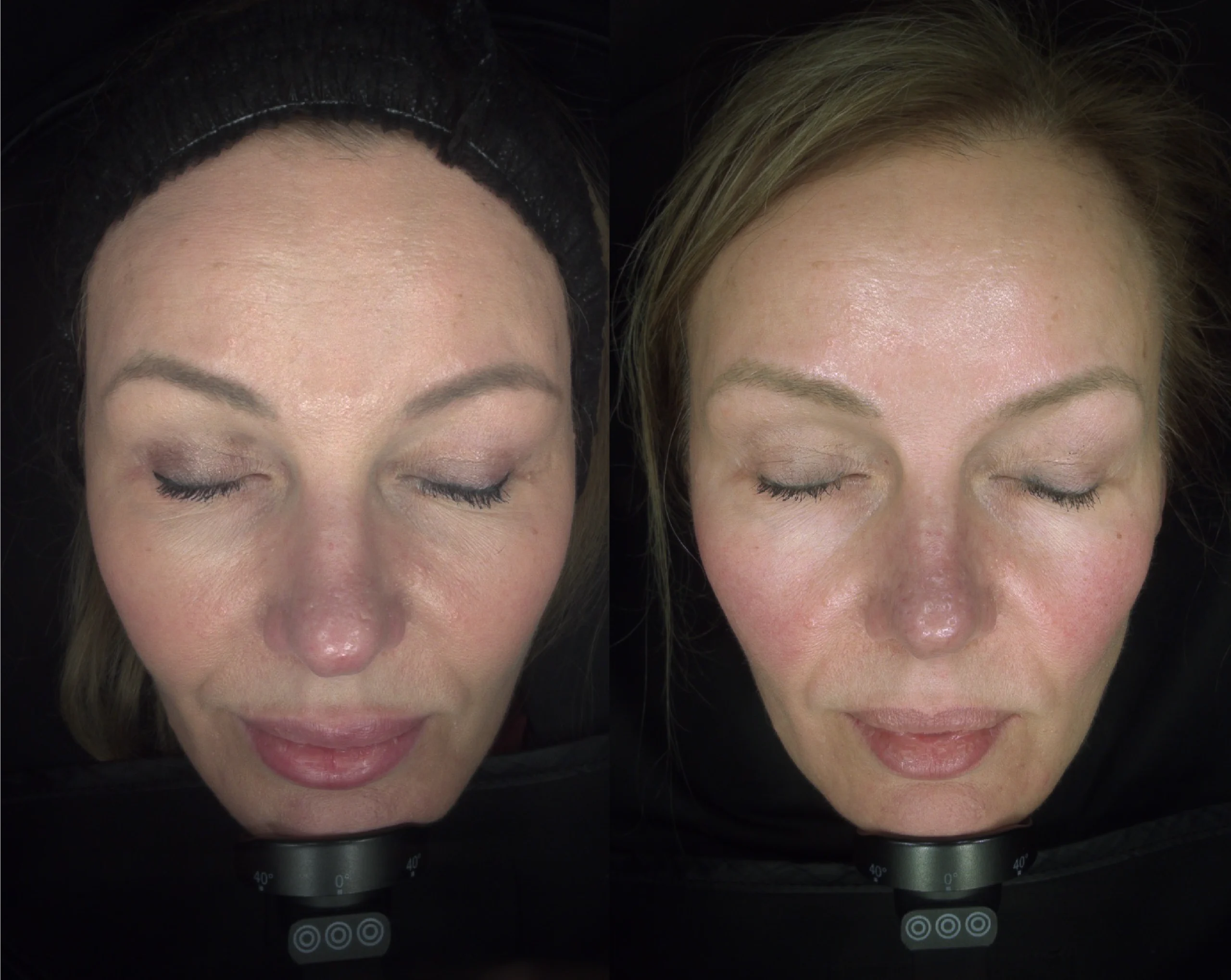Skin before and after at Harmony Medical