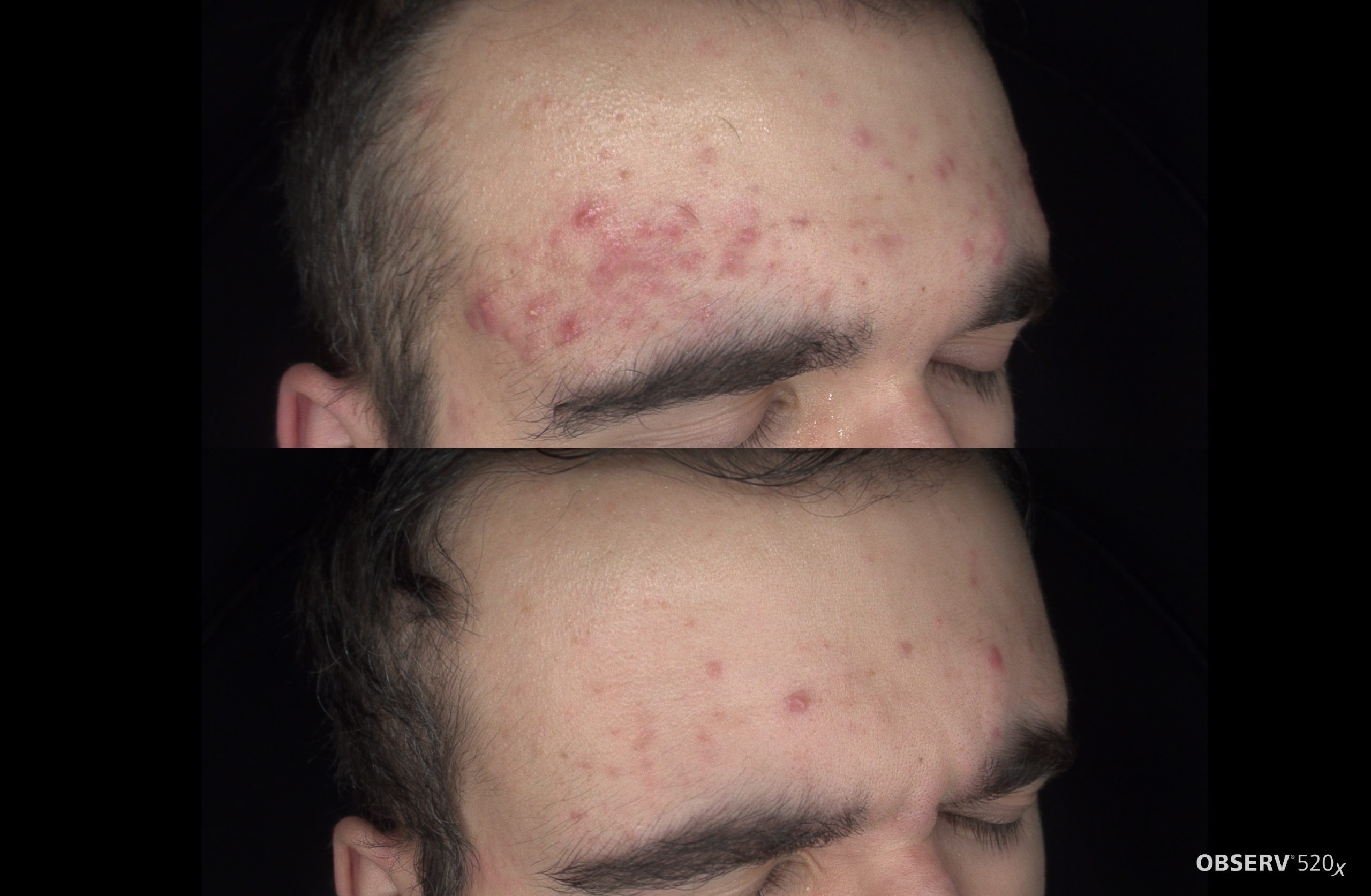 Acne before and after at Harmony Medical