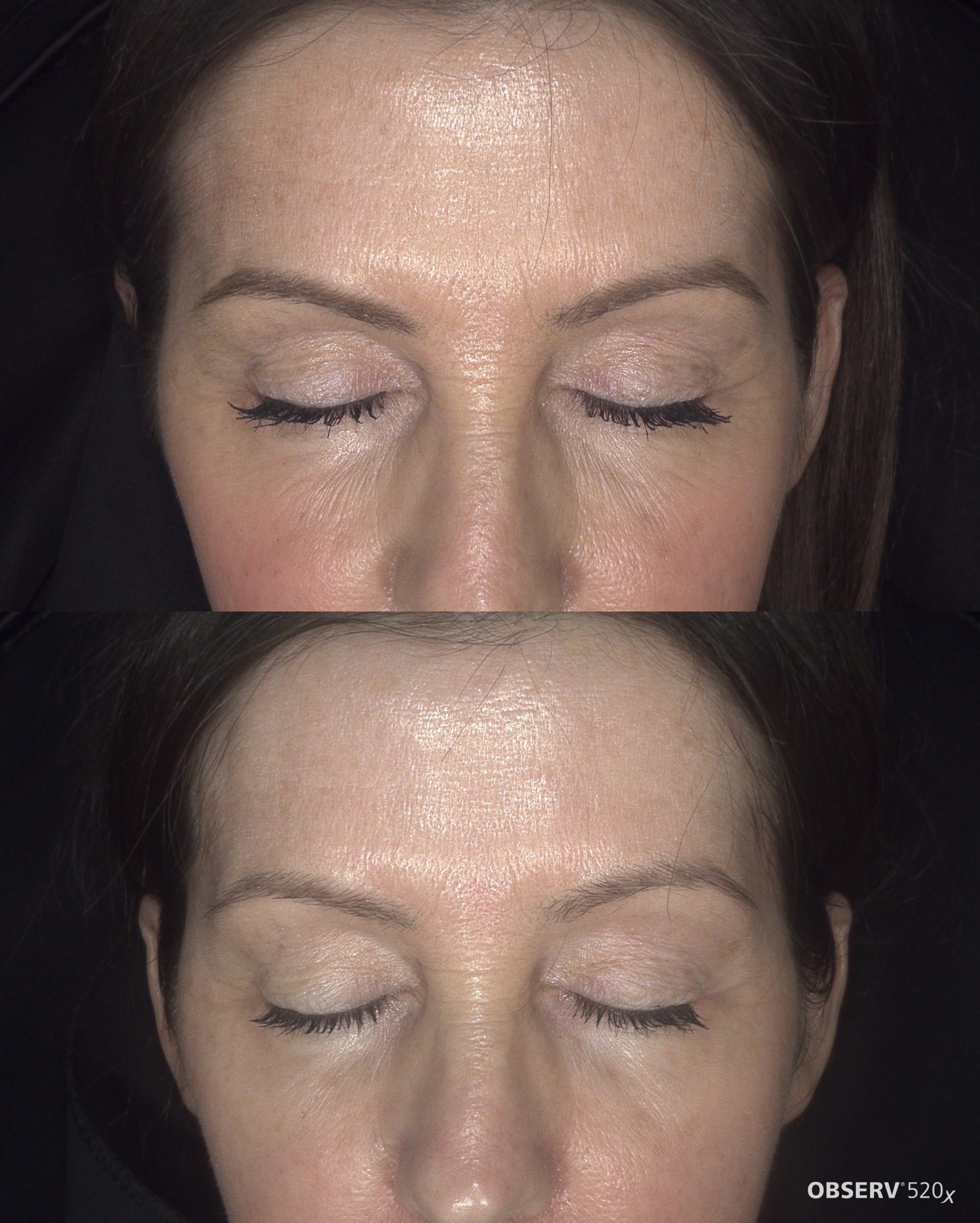 Forehead lines before and after at Harmony Medical