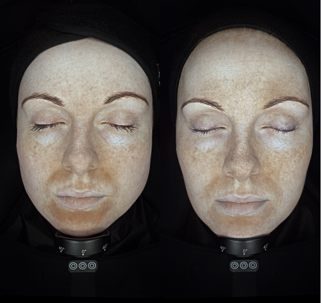 Assessment and laser treatment for pigmentation at Harmony Medical