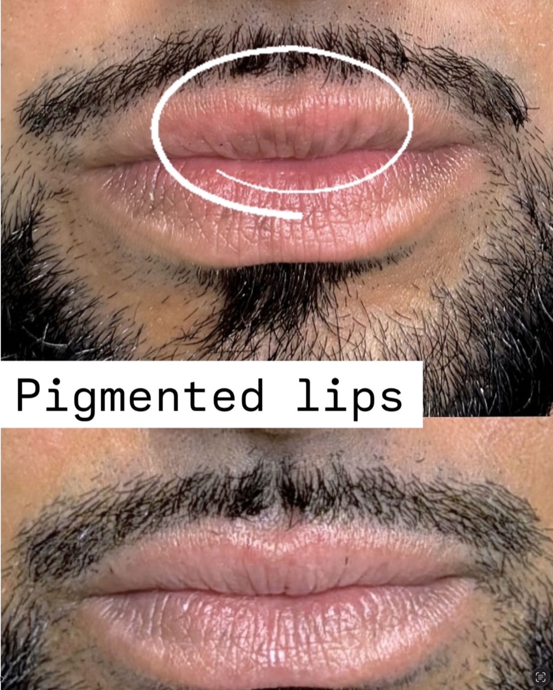 Assessment and laser treatment for pigmentation at Harmony Medical