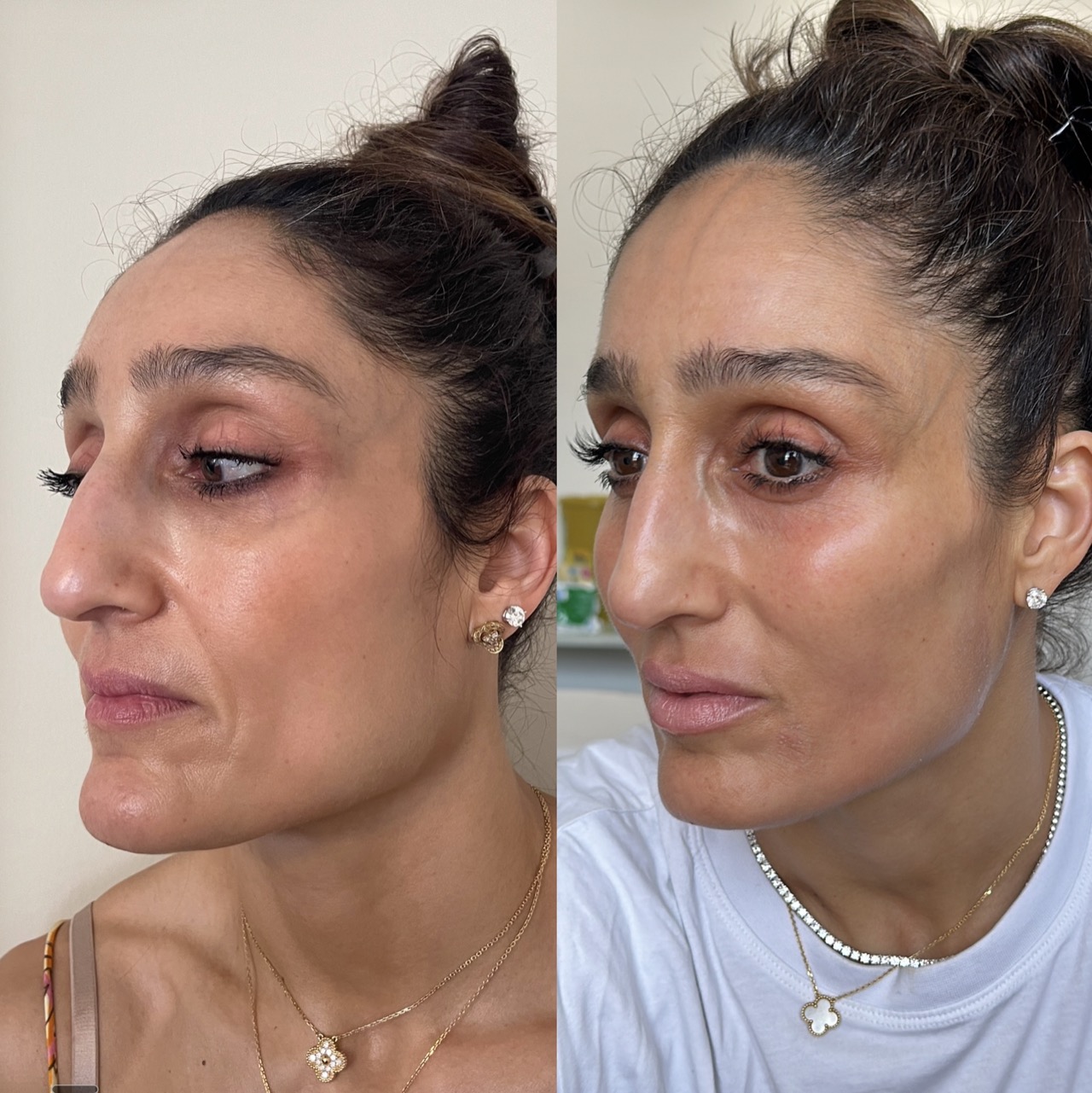 Facial assessment for ageing and volume loss at Harmony Medical