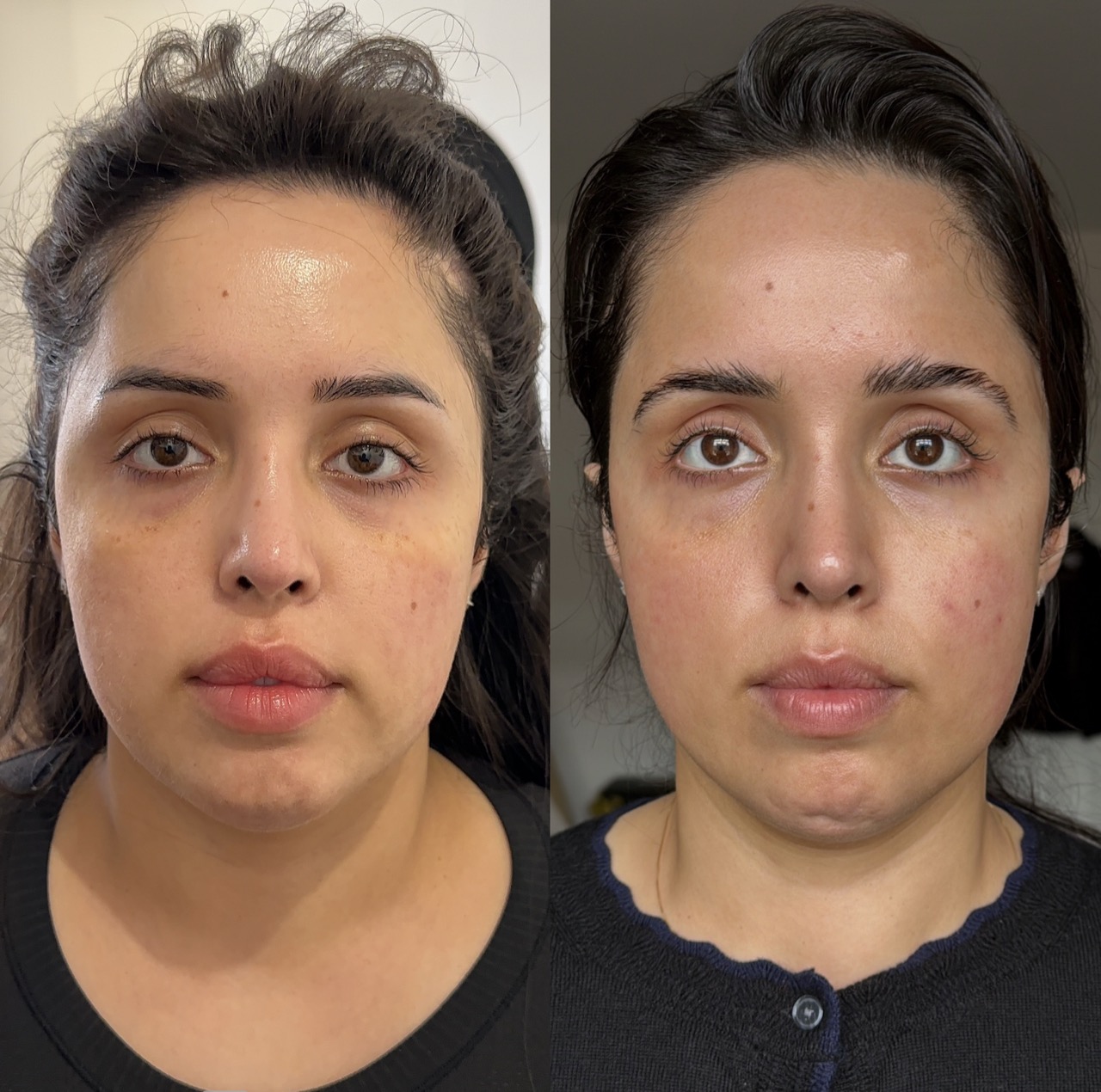Facial assessment for ageing and volume loss at Harmony Medical