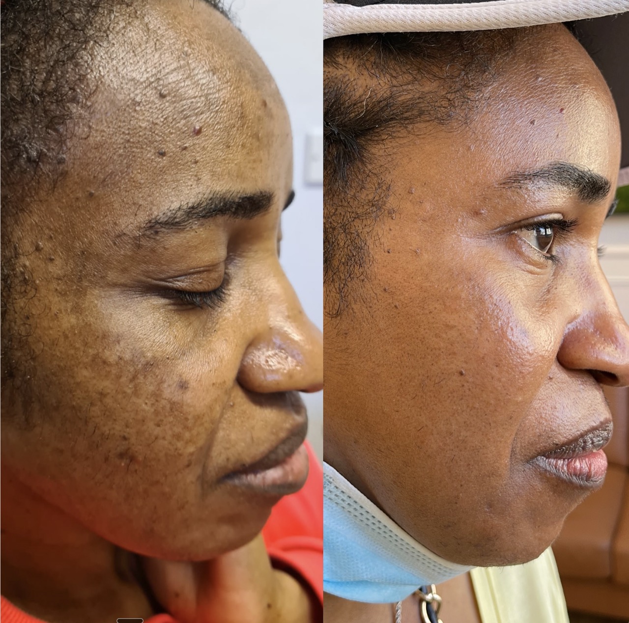 Assessment and laser treatment for pigmentation at Harmony Medical