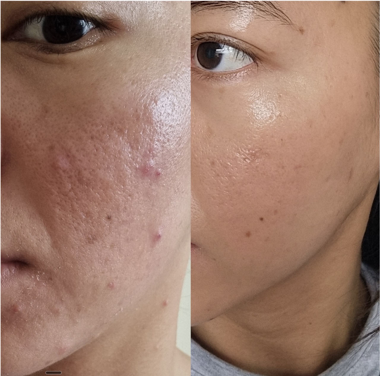 Treatment room for scar and texture treatment at Harmony Medical