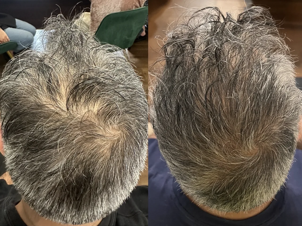 Scalp PRP & exosome injections ultrasound colour Doppler result 1 at Harmony Medical
