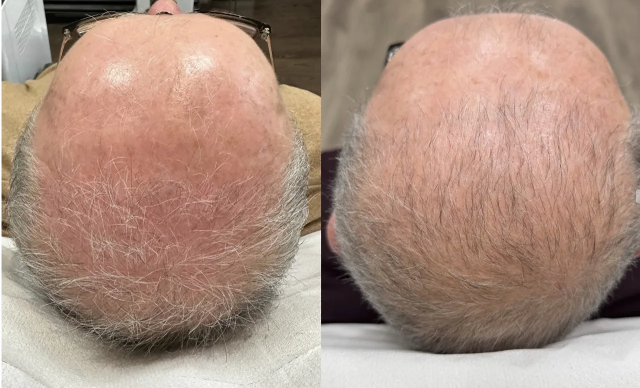 Scalp PRP & exosome injections ultrasound colour Doppler result 2 at Harmony Medical