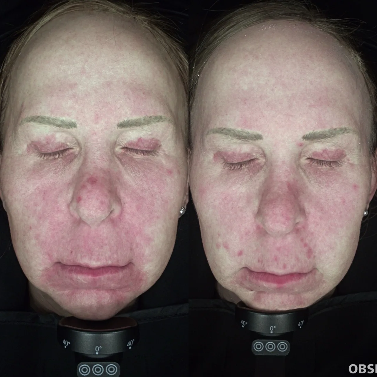 Laser Genesis ultrasound colour Doppler result 3 at Harmony Medical