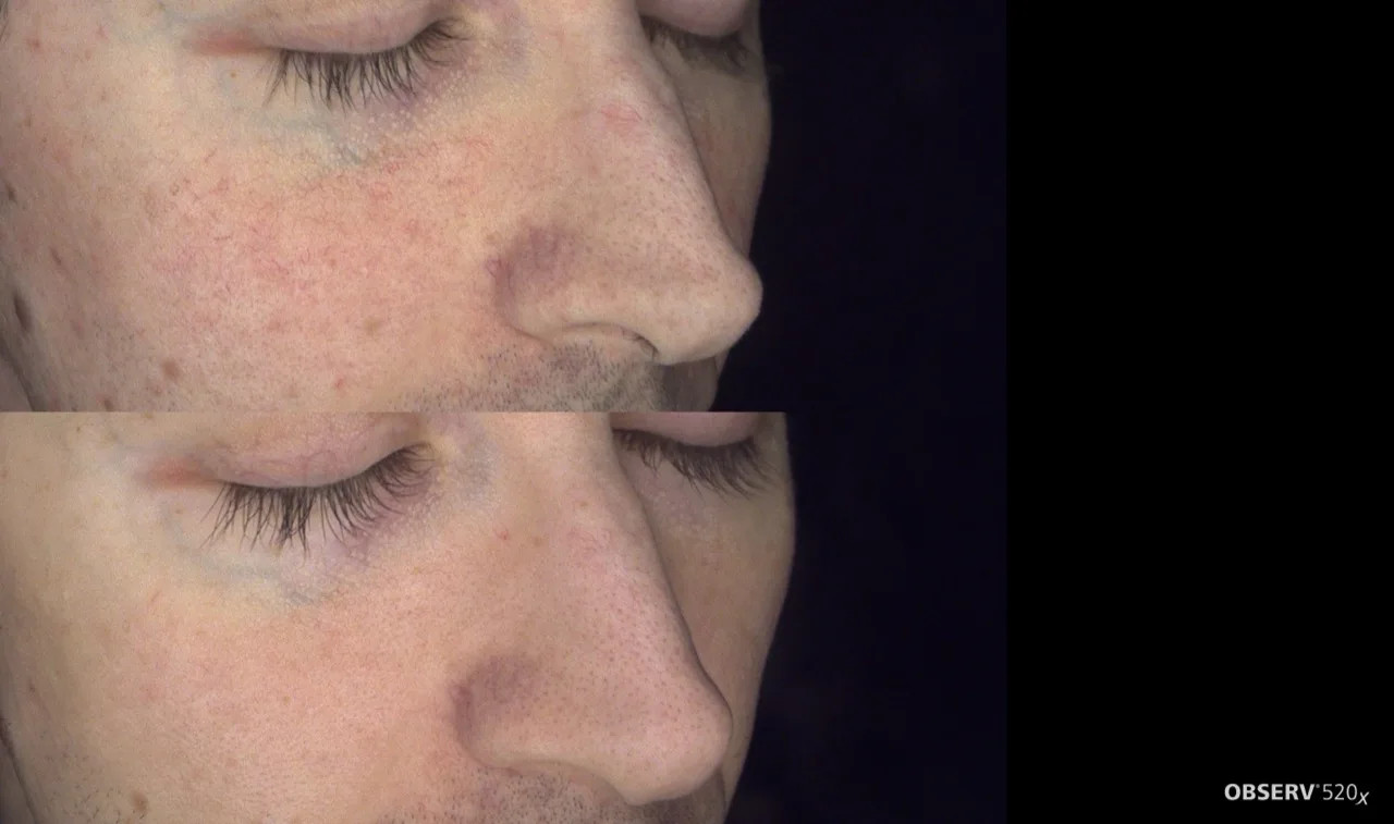 Laser Genesis ultrasound colour Doppler result 4 at Harmony Medical