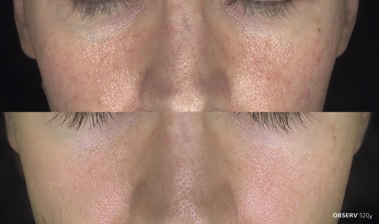 Laser Genesis ultrasound colour Doppler result 5 at Harmony Medical