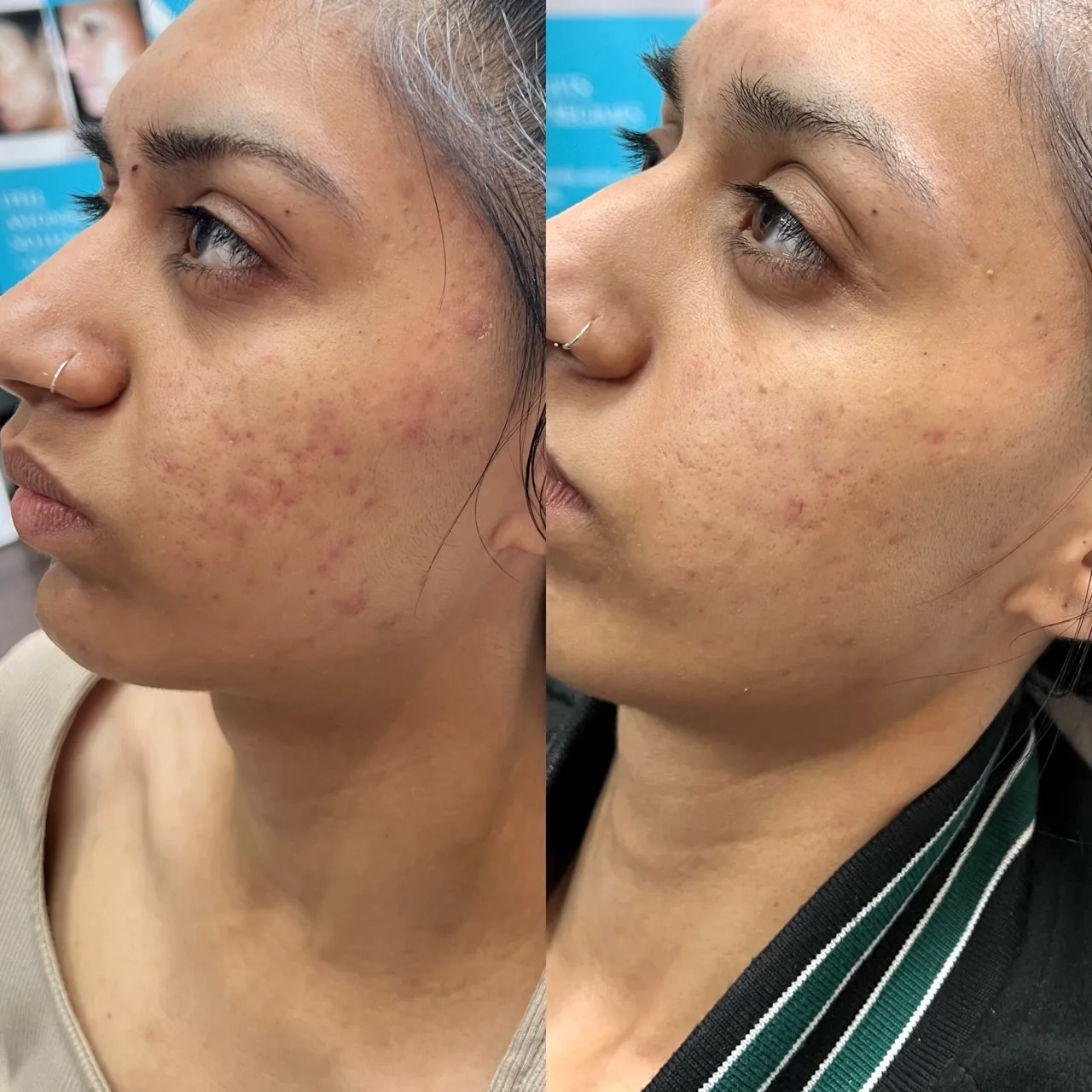 Chemical peels ultrasound colour Doppler result 2 at Harmony Medical