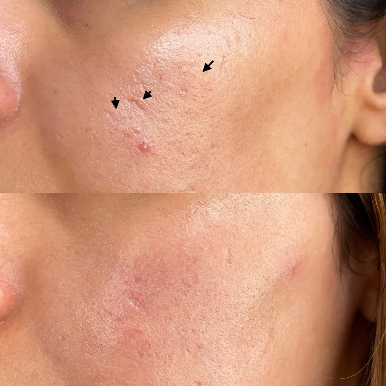 Chemical peels ultrasound colour Doppler result 3 at Harmony Medical