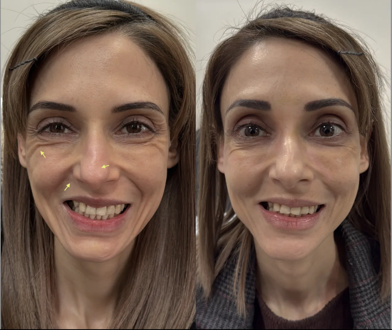 Post-filler rehab ultrasound colour Doppler result 5 at Harmony Medical