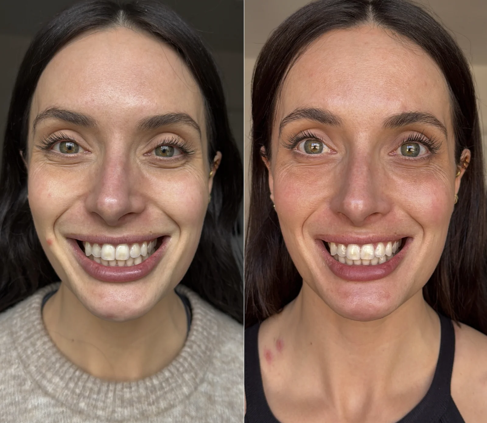 Filler dissolving before and after at Harmony Medical