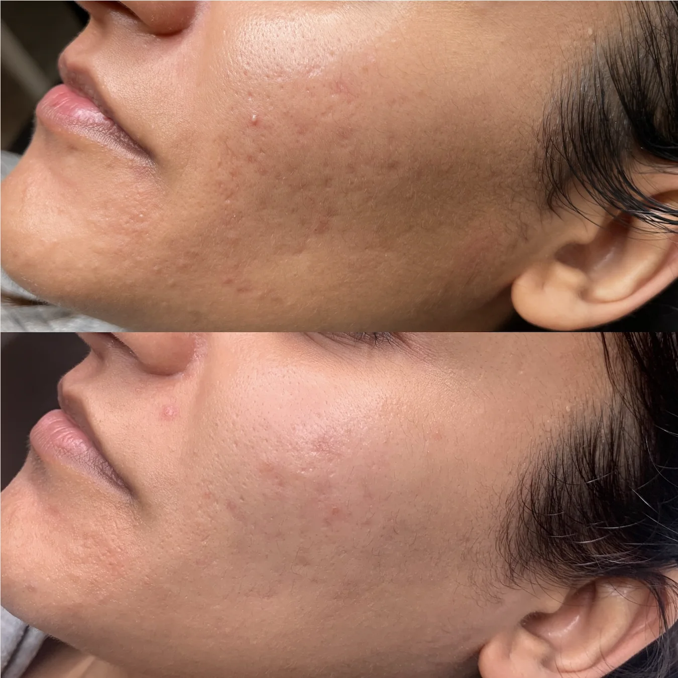 TCA CROSS acne scar result 1 at Harmony Medical