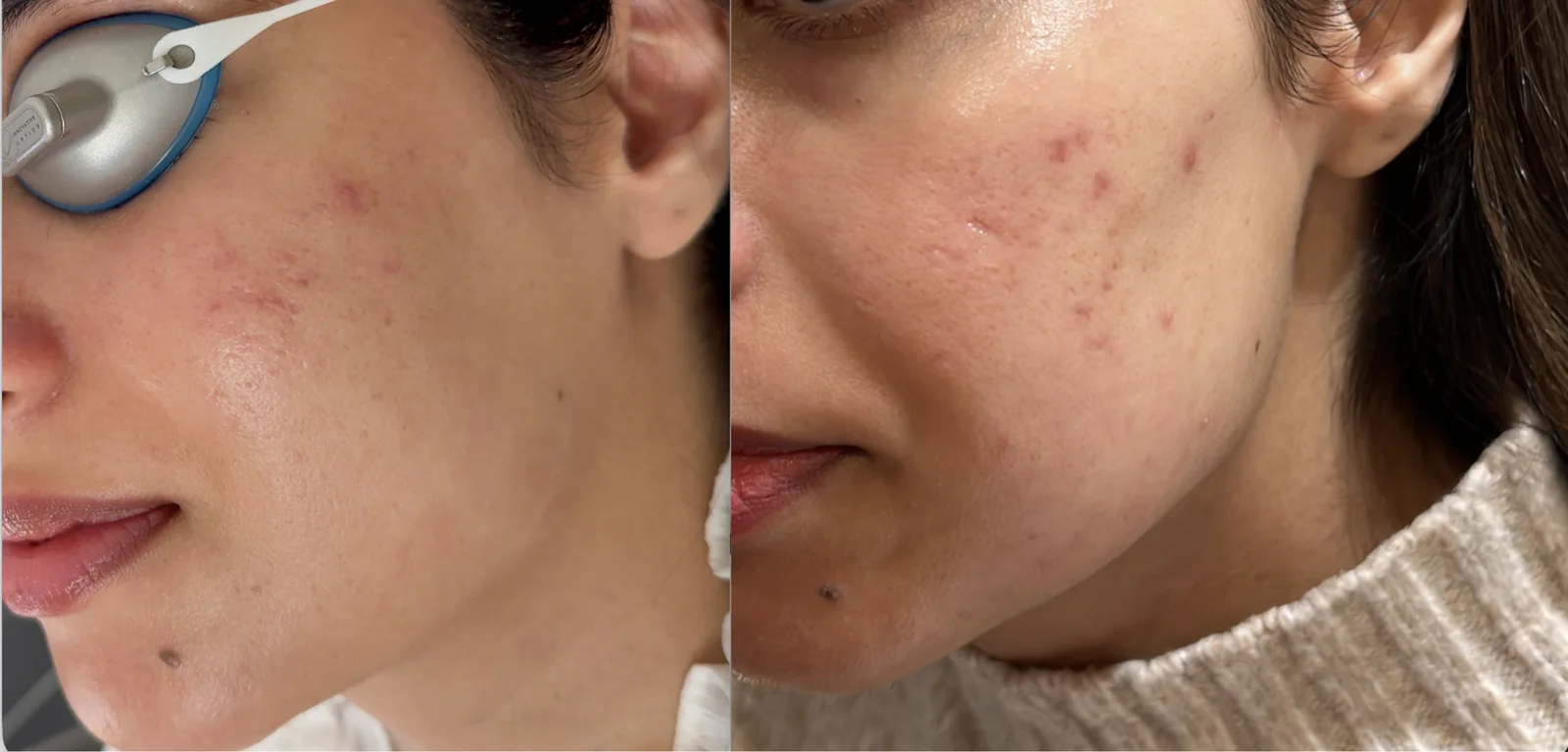 TCA CROSS acne scar result 3 at Harmony Medical